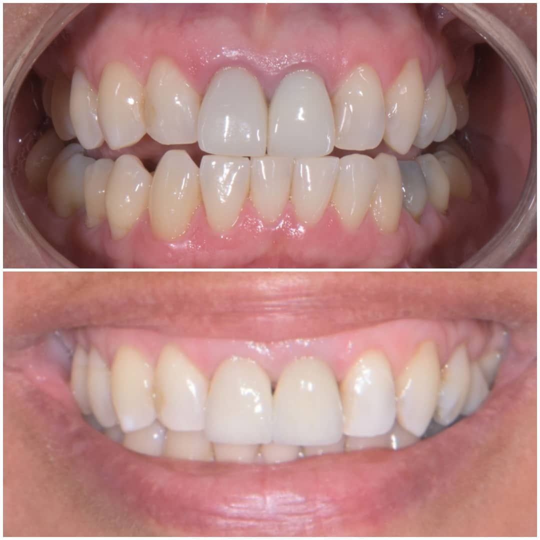 Avant / Après en gros plan sur les dents d'un patient