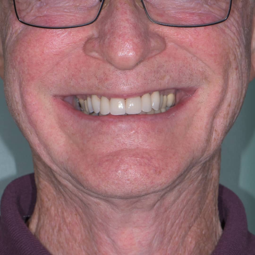 Gros plan sur les dents d'un patient