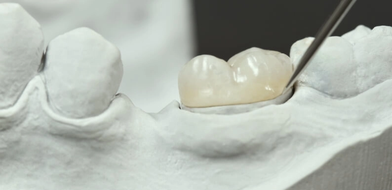 Moulure de la bouche d'un patient utilisée pour calibrer une prothèse dentaire en céramique
