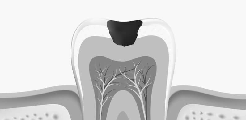Dessin d'une dent avec une carie de taille moyenne affectant la dentine de la dent