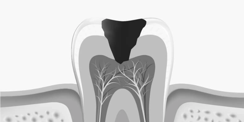 Dessin d'une dent avec une carie de grosse taille affectant le nerf de la dent