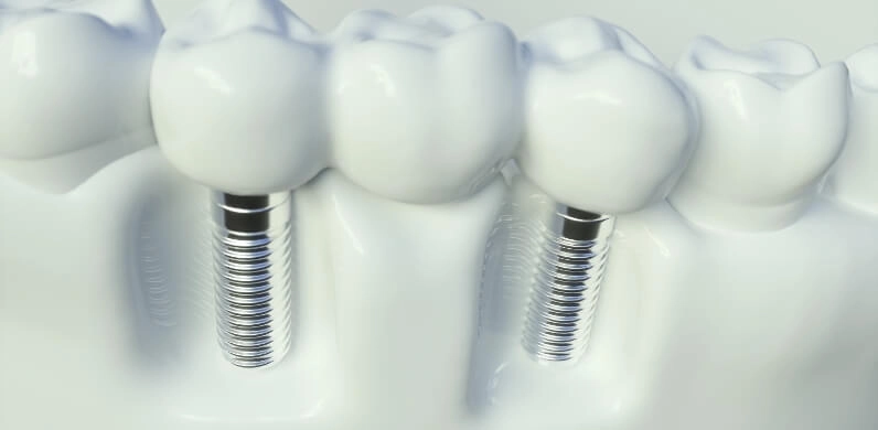 Imagerie de synthèse de deux implants dentaires