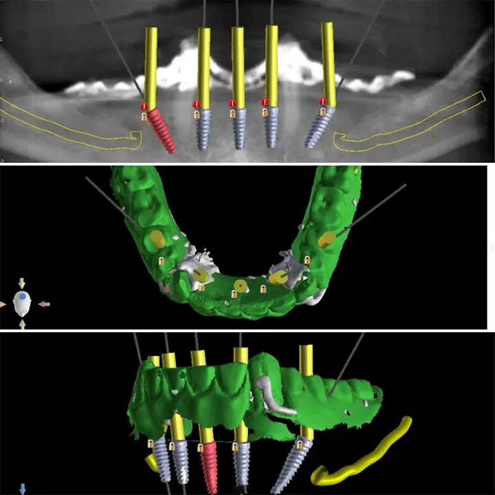 Radio et imagerie de synthèse de la pose de plusieurs implants