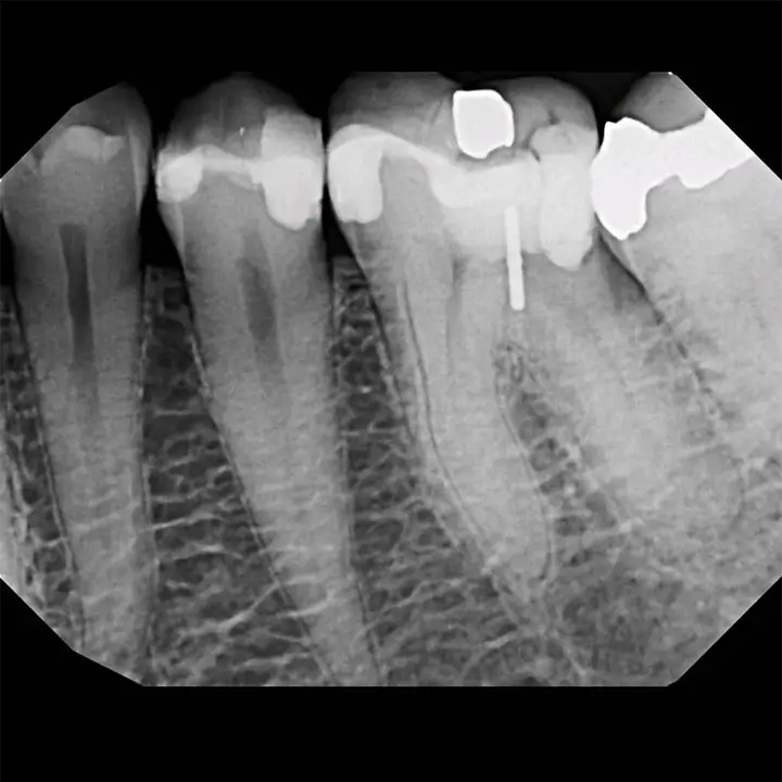 Photo d'un implant dentaire